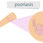 Psoriasis