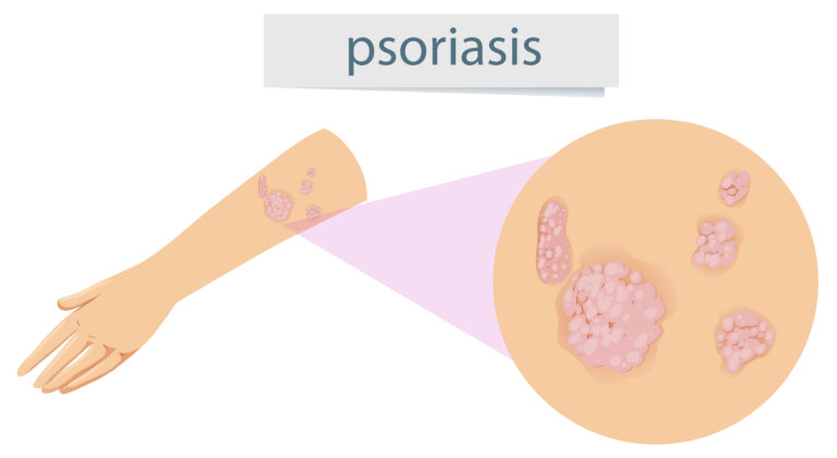 Psoriasis