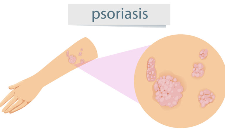 Tips To Get Rid of Psoriasis