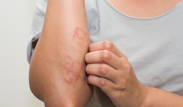 Tips for Managing Eczema Symptoms and Preventing Flare-Ups